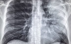 Peste 5.500 de cazuri de pneumonie, înregistrate la Spitalul de Pneumoftiziologie, în acest an